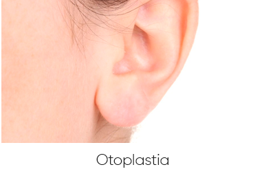 OTOPLASTIA