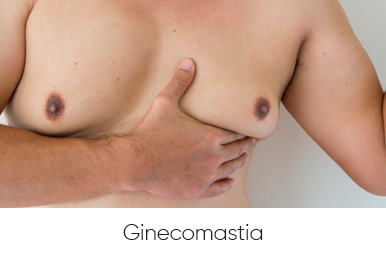 ginecomastia