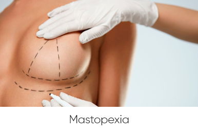 mastopexia